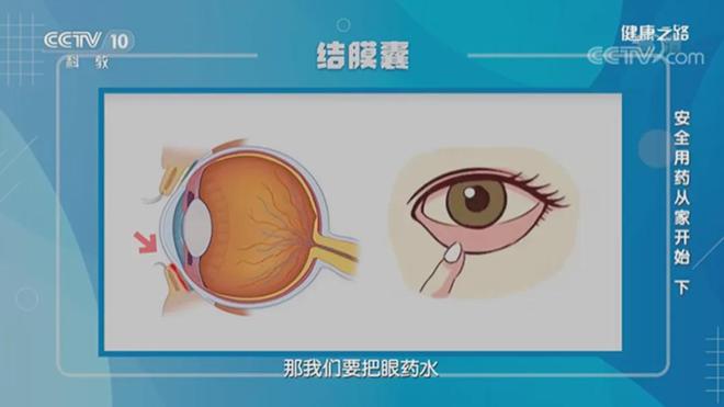 網(wǎng)紅眼藥水致視力僅剩0.1