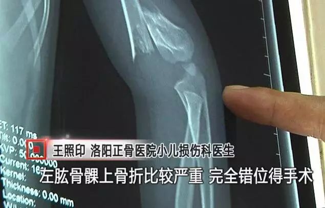 藝考前十天被抱摔骨折