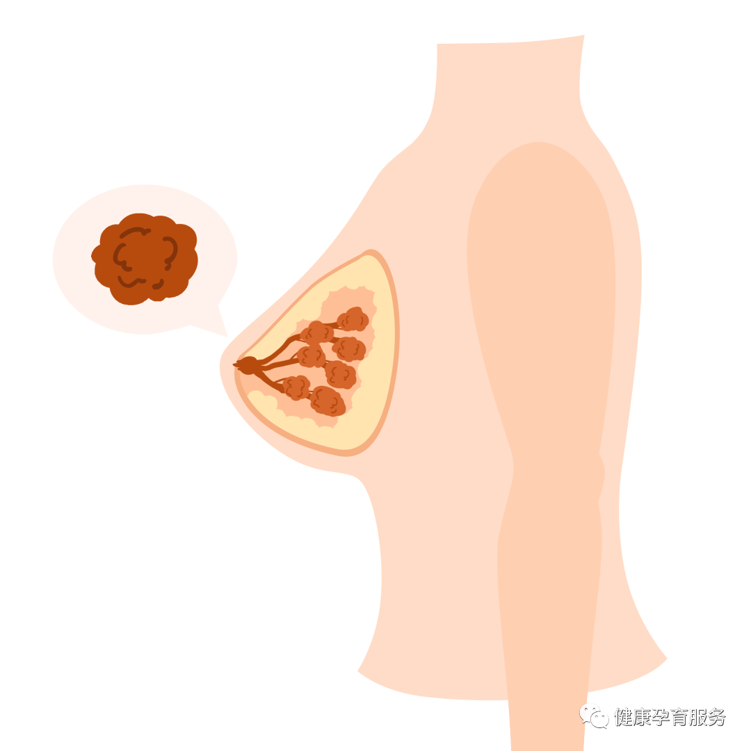 乳房長疙瘩沒在意，檢查竟是乳腺癌