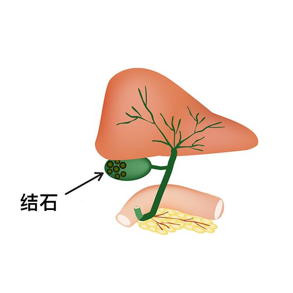 吃播是否會引發(fā)膽結(jié)石？