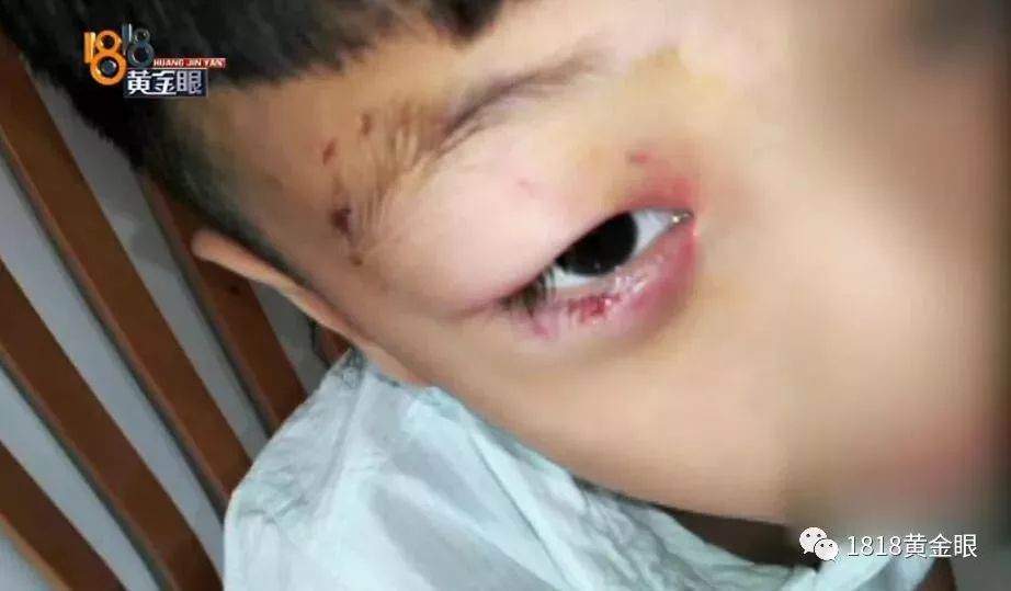 被咬傷男童可通過(guò)換血控制感染
